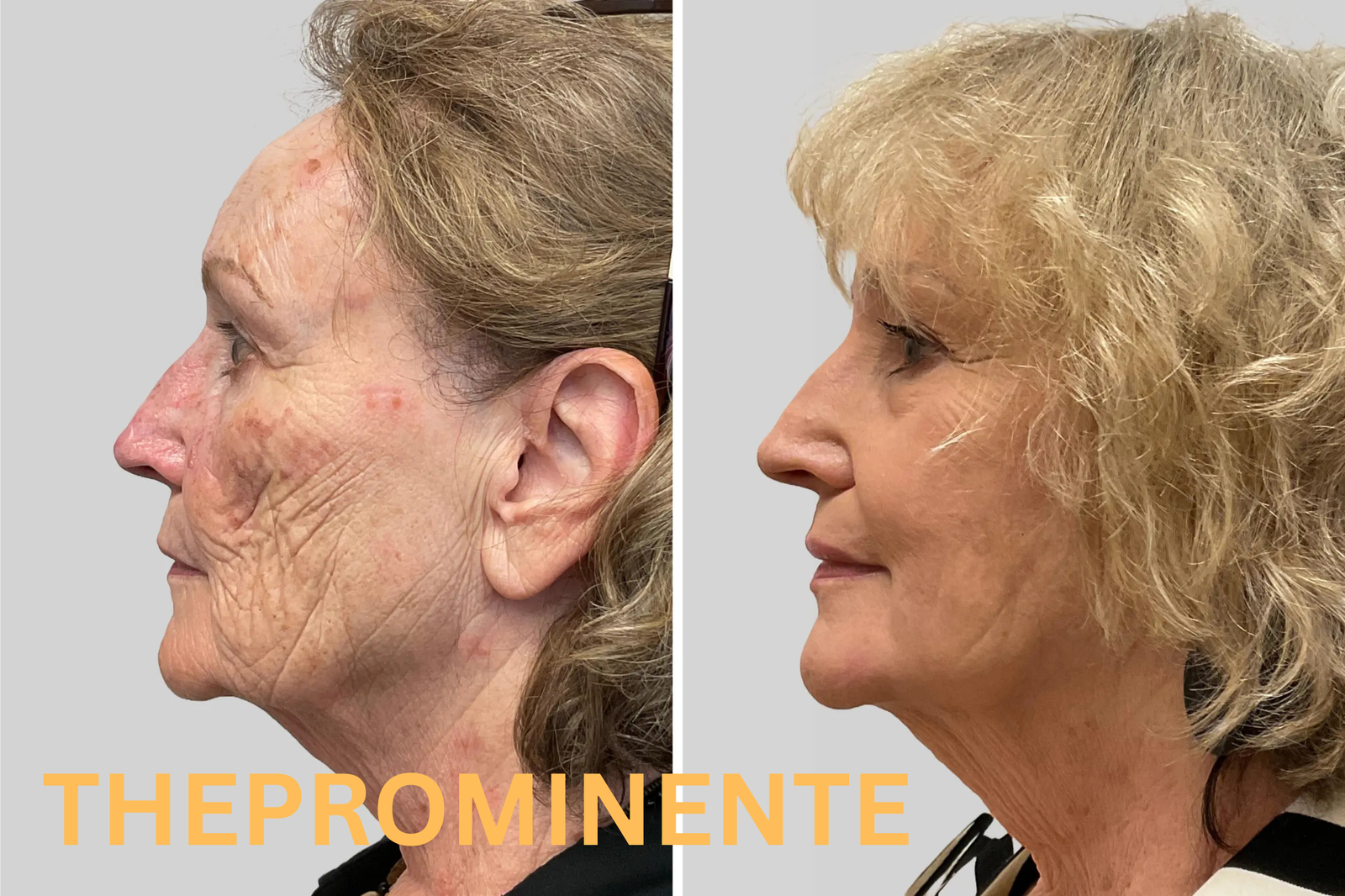Phenol Peeling – Die tiefgreifende Hauterneuerung mit Langzeitwirkung