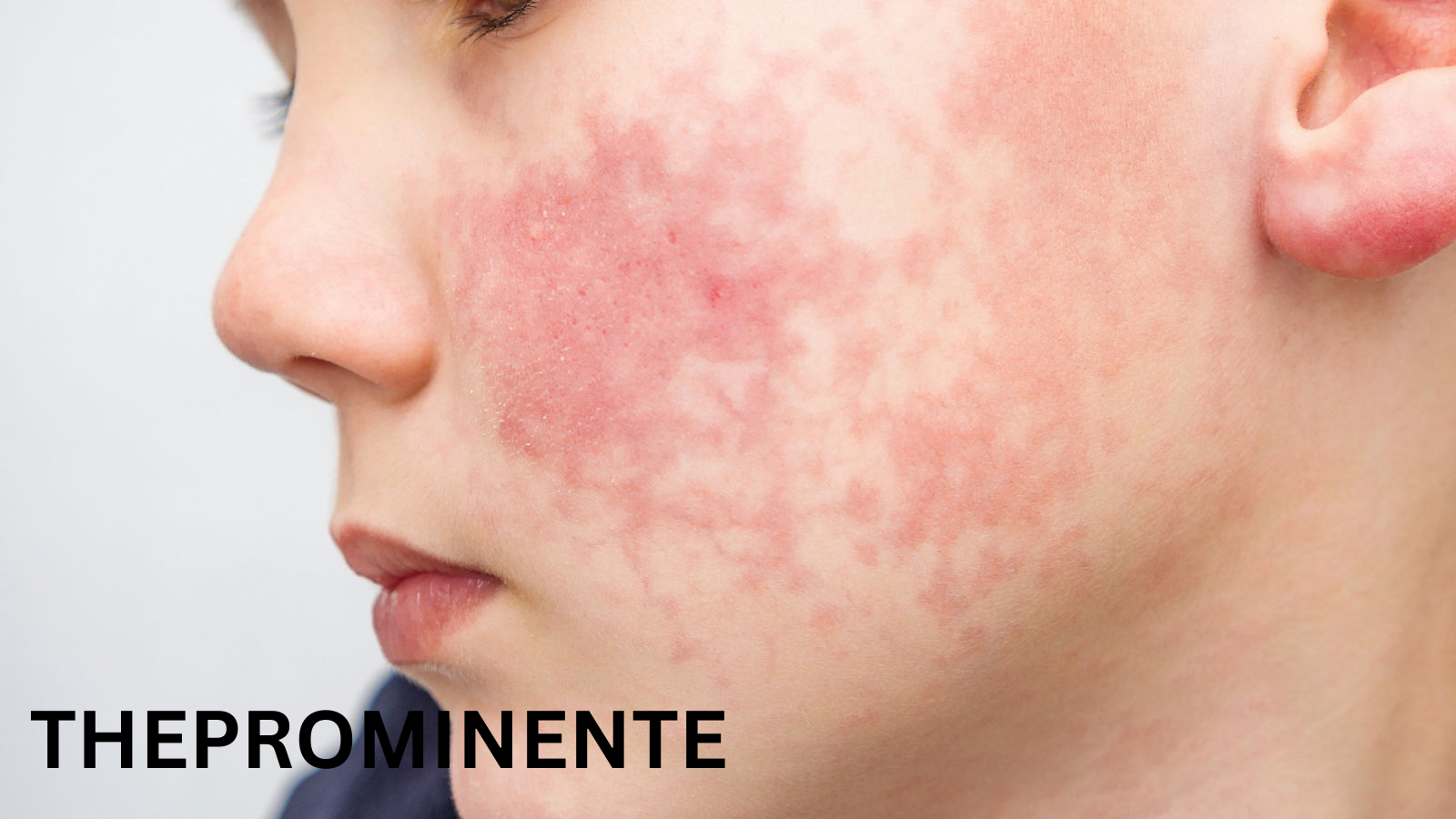 Ringelröteln Schwangerschaft 3. Trimester – Risiken, Schutzmaßnahmen und medizinische Einschätzung